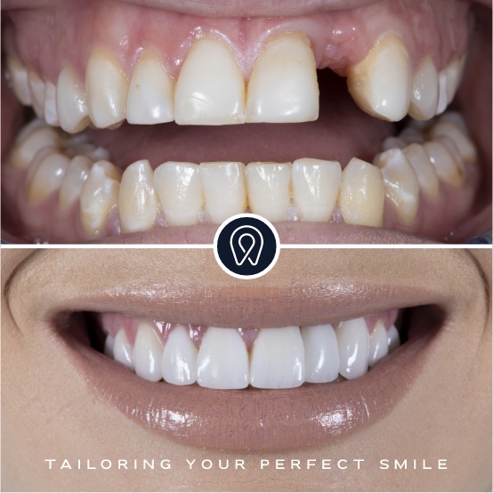 teeth whitening and repair at sydney smile doctor penrith